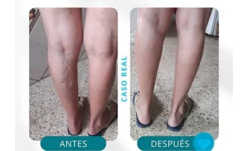 Esclero